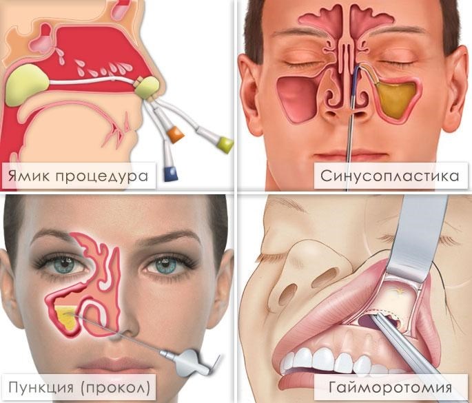 Гипертрофия аденоидов. Гипертрофия небных миндалин