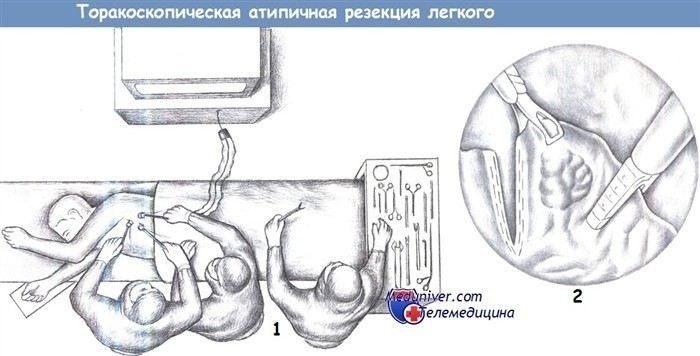 Показания к атипичной резекции верхней доли легкого