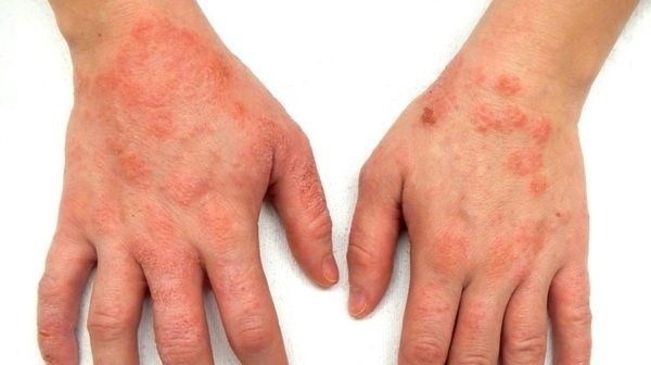 Какие виды экземы учитываются при медкомиссии для армии?