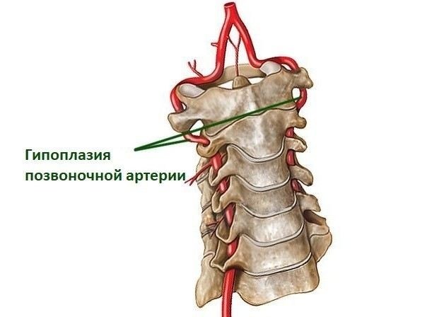 Как диагностировать гипоплазию позвоночной артерии: методы и особенности обследования