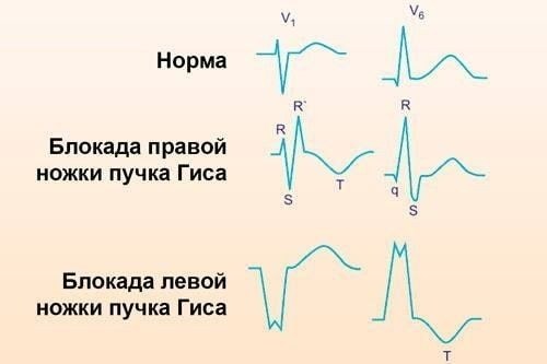 Методы лечения блокады ножек пучка Гиса