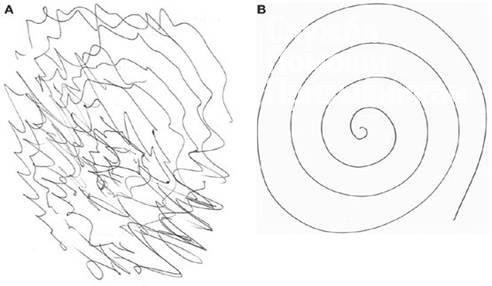 Берут ли в армию с тремором от стресса?
