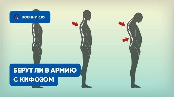 Критерии призывного возраста и медицинские ограничения при кифозе