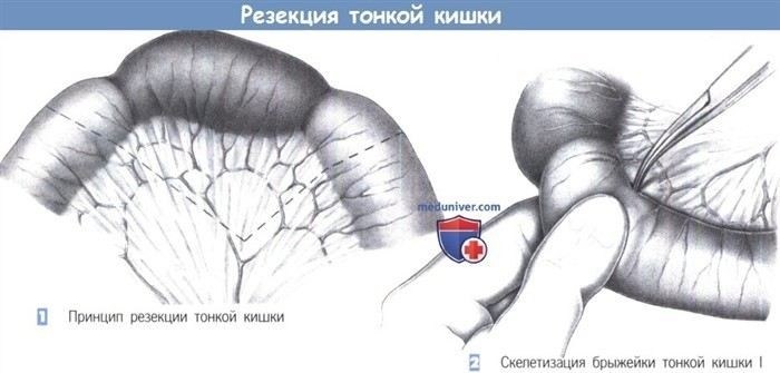 Причины, по которым требуется резекция тонкой кишки