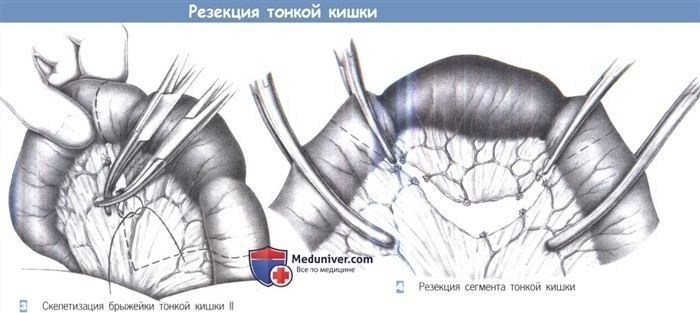 Риски и осложнения при резекции тонкой кишки