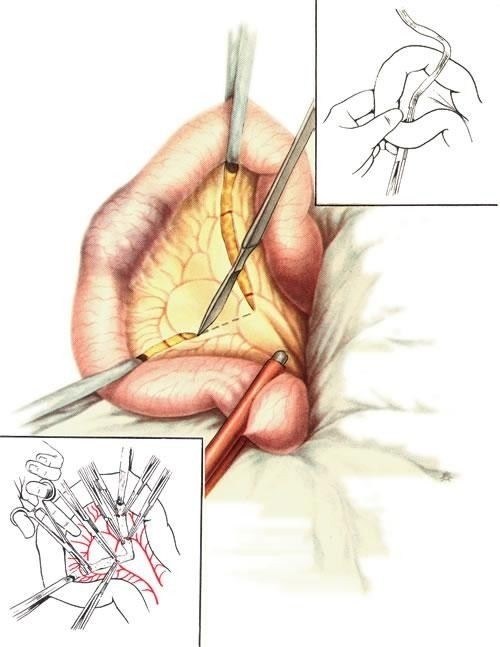 Как проводится операция по удалению части тонкой кишки