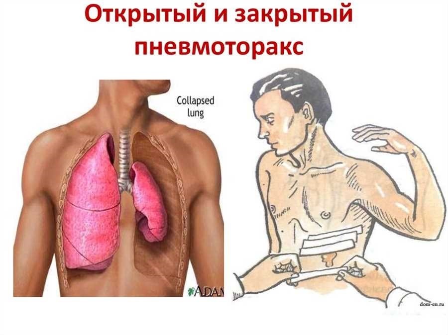 Может ли пневмоторакс пройти самостоятельно