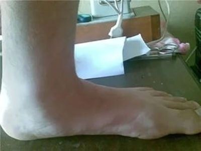 Какие симптомы и сопутствующие диагнозы могут изменить категорию годности