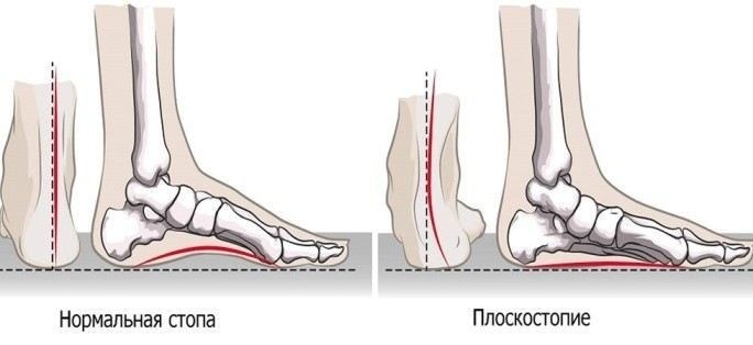 Какие виды плоскостопия влияют на призыв в армию?