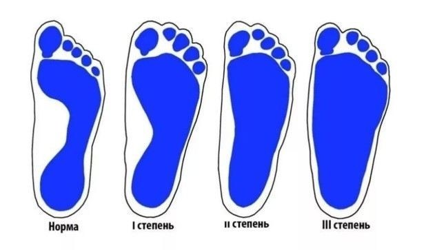 Плоскостопие и военные билеты: как это влияет на категорию годности?