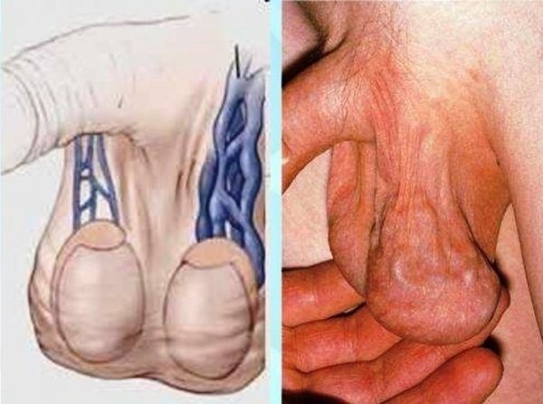 Медицинская комиссия и диагностика варикоцелле: как проходят обследования?