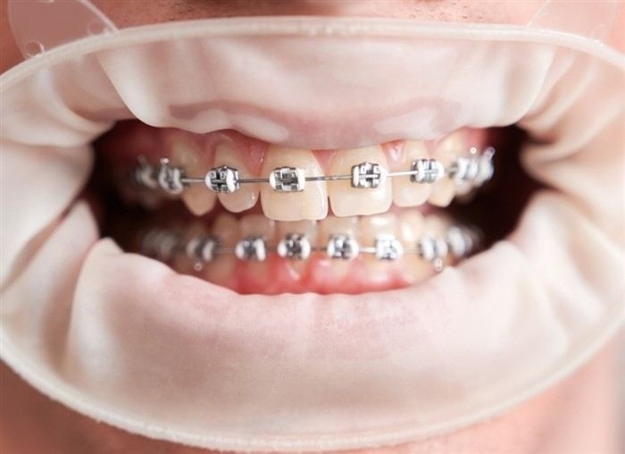 Считаются ли брекеты основанием для освобождения от службы или это не влияет на призыв