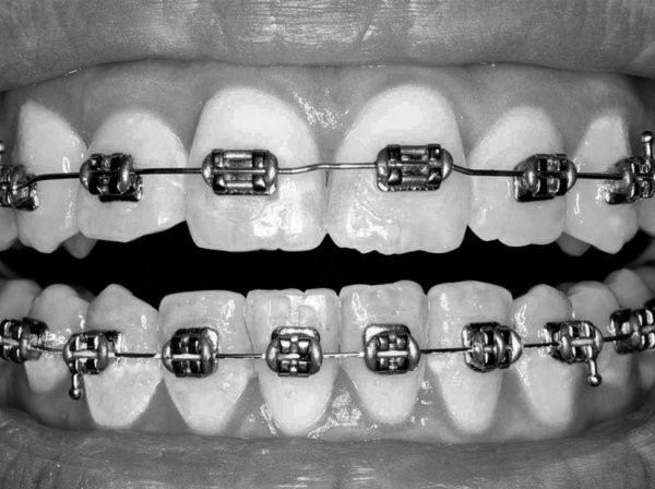 Как проходит медкомиссия, если стоят брекеты: что проверяют и на что обращают внимание