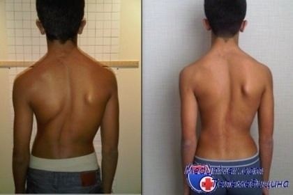 Медицинская комиссия: что учитывать при диагнозе сколиоз