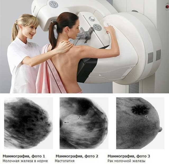 Сколько можно делать маммографию в год