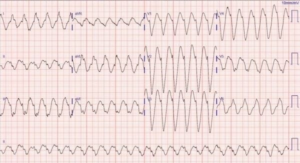 Как тахикардия влияет на категорию годности к военной службе?