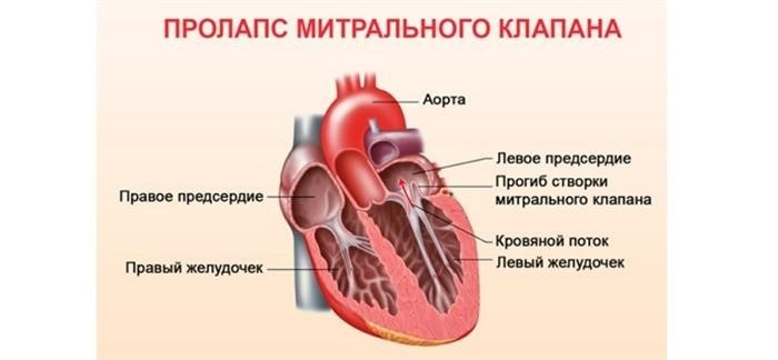 опущение матки