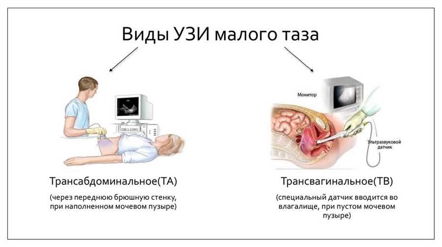 Вредно ли делать узи малого таза