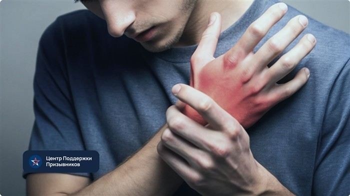 Можно ли получить освобождение от армии при крапивнице?