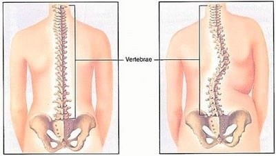 Сколиоз 2 степени: подлежит ли призыву в армию?