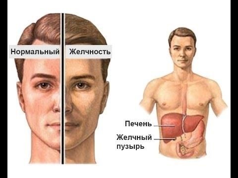 Как классифицируется синдром Жильбера в военно-медицинских руководствах