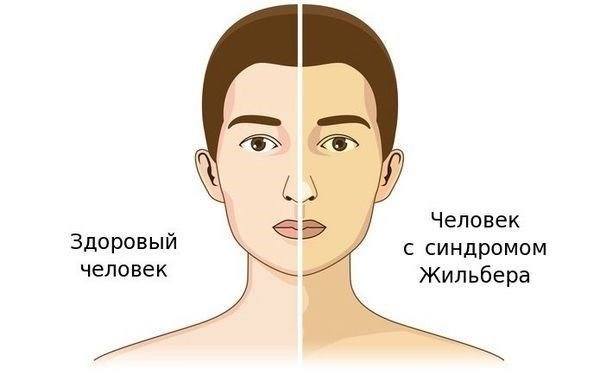 Пригодность к призыву в случае данного заболевания печени